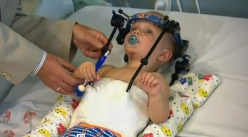 Médicos australianos logran unir la cabeza y la columna de un bebé