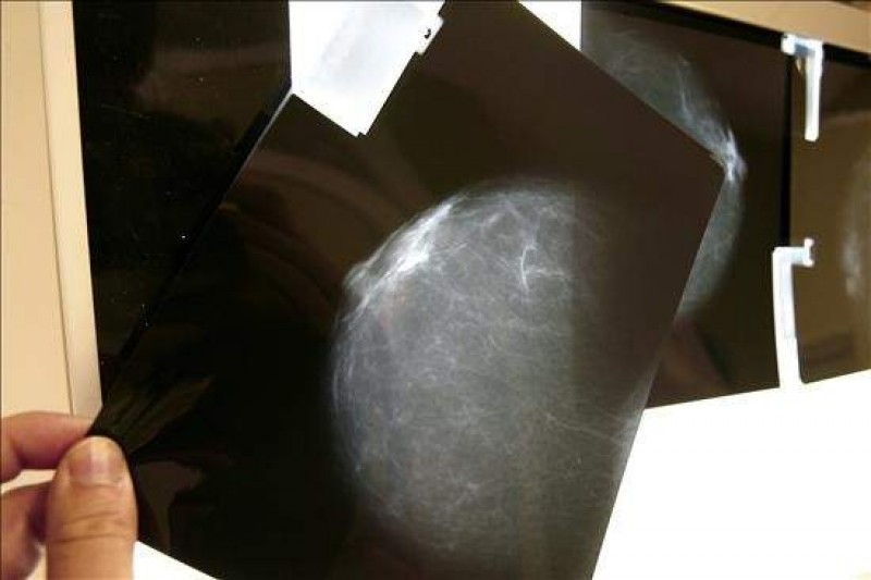 La Sociedad Americana del Cáncer aconseja retrasar las mamografías a los 45 años