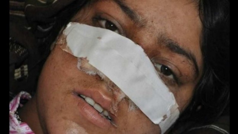 Un afgano le corta la nariz a su esposa y huye