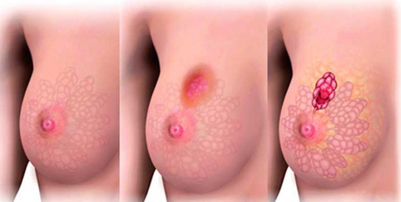Descubren más de 70 variantes genéticas que elevan riesgo de cáncer de mama