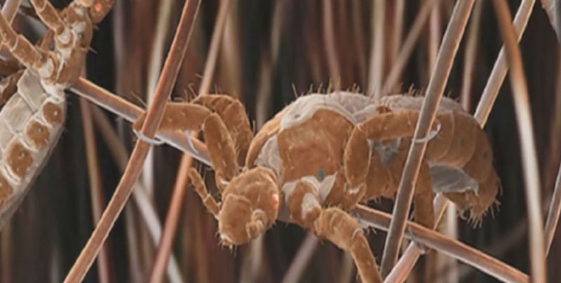 Pediculosis puede afectar a cualquier persona