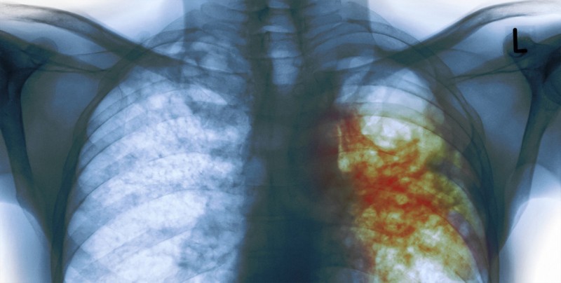 Quince países de Latinoamérica debaten en Lima políticas contra tuberculosis