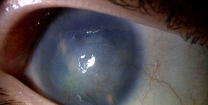 Glaucoma es una enfermedad crónica degenerativa