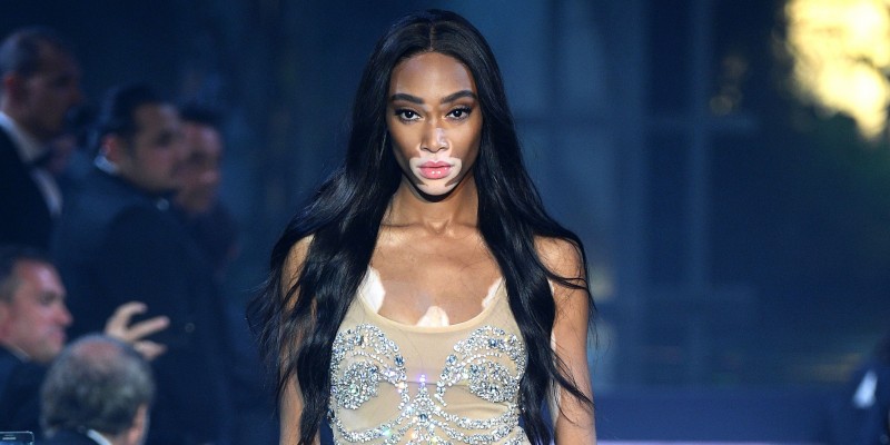 Modelo con vitiligio será parte del Victoria Secret Fashion Show | #Lo más  visto en redes | Noticias | TVP 