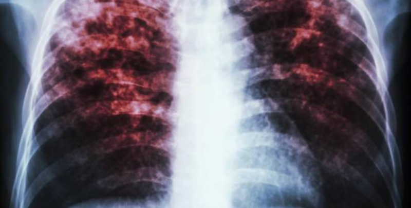Sinaloa cuenta con tratamientos para la tuberculosis