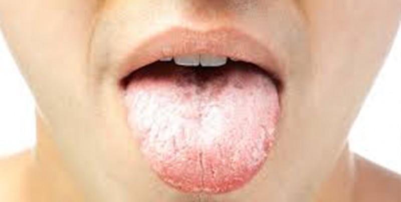 Por qué tienes la lengua blanca y cómo lo puedes eliminar