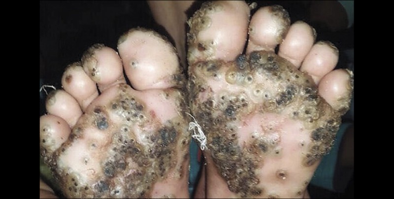 Niña por caminar descalza se infecta de pulgas