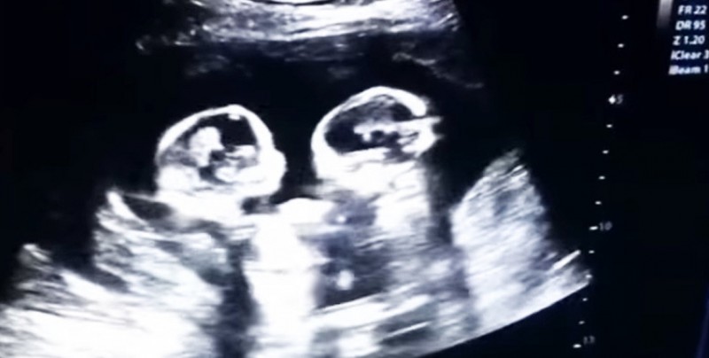 VIDEO: Ecografía muestras la 'pelea' entre dos gemelas en el vientre de su madre