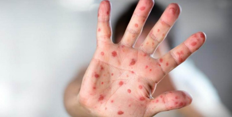 México halla enfermos de varicela y sarampión entre 289 migrantes detenidos
