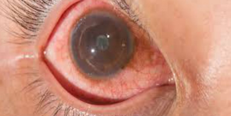 Uveítis  inflamación que afecta la capa interna del ojo