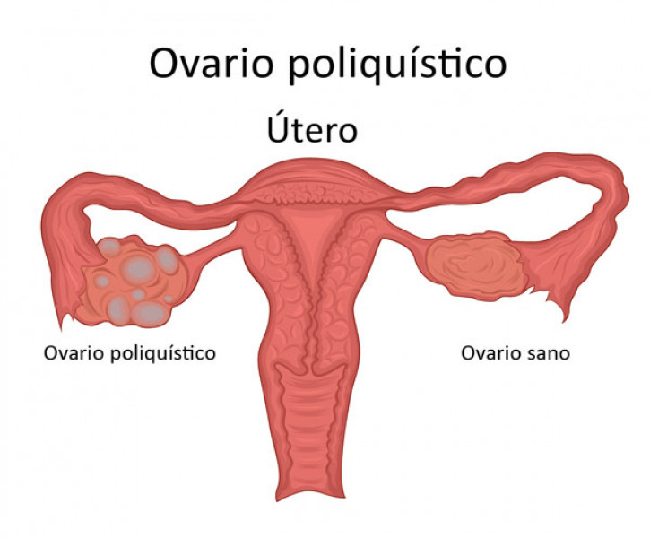 Síndrome de Ovario Poliquístico es un trastorno hormonal frecuente