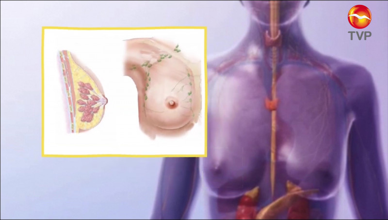 17 mujeres mueren por cáncer de mama al día en México: Fundación Bella