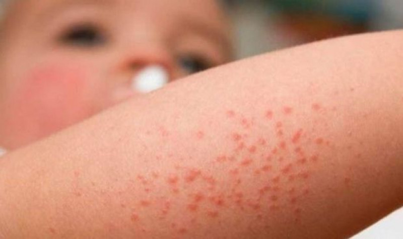 La dermatitis atópica, una enfermedad crónica con cada vez mejor tratamiento