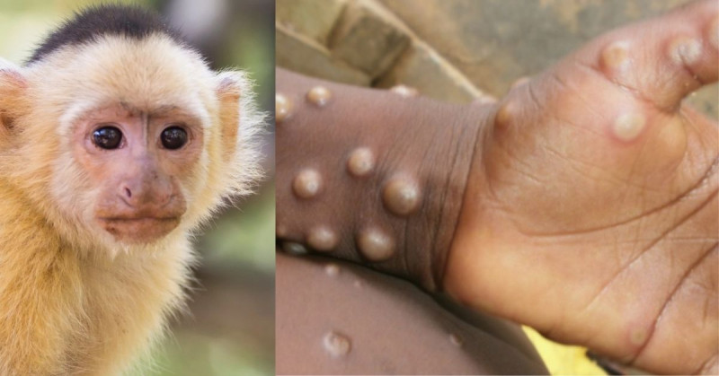 EEUU en alerta por 200 expuestos a rara viruela de mono tras vuelo nigeriano