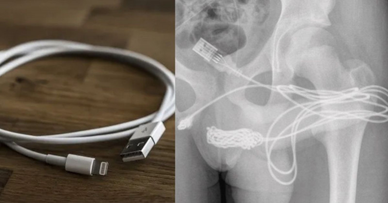 Cable USB termina dentro de uretra de joven tras intentar medirse el pene por dentro