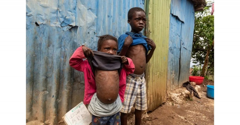 Haití sufre contagiosa epidemia similar a la sarna