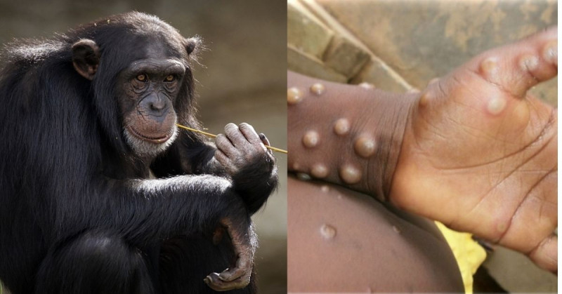 OMS dice que viruela del mono es controlable en O. Medio y el riesgo es bajo
