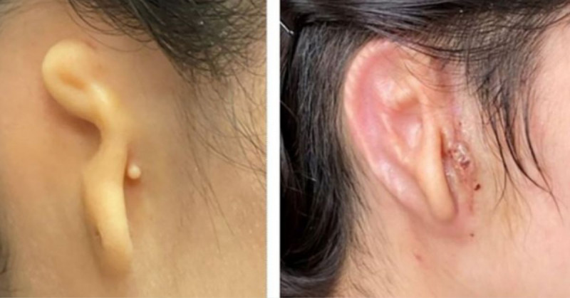 Mujer recibe oreja impresa en 3D hecha con sus propias células