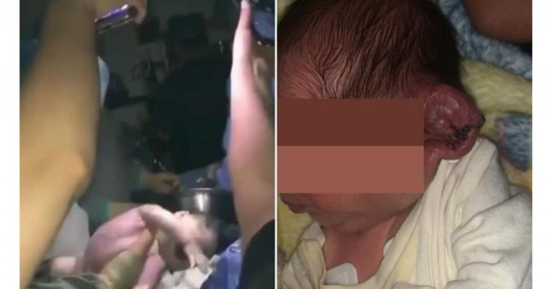 Se va la luz en hospital de Mexicali y doctores cortan oreja a bebé