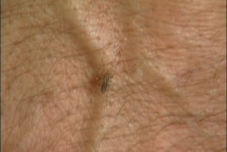 Sinaloa entre los estados con mayor casos de dengue
