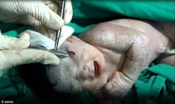 Nace en Siria una bebé con una herida producida por la metralla que hirió a su madre