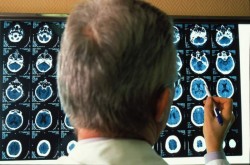 Científicos confirman que el alzhéimer puede combatirse con fármacos