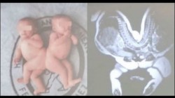 Separan con éxito a siamesas en el Hospital Infantil de México