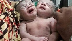 Nace un bebé con dos cabezas en Bangladesh