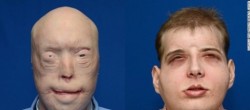 Estados Unidos realiza el trasplante de cara más completo a un bombero desfigurado