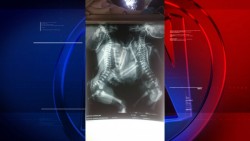 Nacen siameses en el Hospital General de Mazatlán