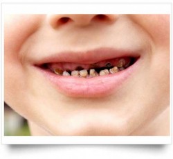 Grave problema de caries en niños de Sinaloa: dentistas.