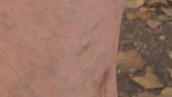 Se incrementan molestias de varices en temporada de calor