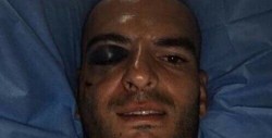 Lucero Álvarez sufre fractura de pómulo en partido frente a Querétaro