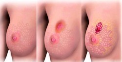 Descubren más de 70 variantes genéticas que elevan riesgo de cáncer de mama
