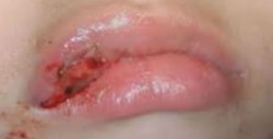 Herpes labial es muy contagioso