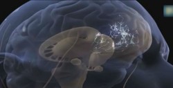 Más casos de migraña por estrés