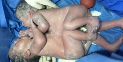 Separan con éxito a siameses unidos por tórax y abdomen