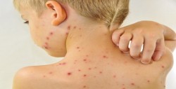 R.Dominicana registra más de 3.300 casos de varicela en cuatro semanas