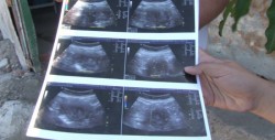 No estaba embarazada mujer de 70 años; resultó ser un tumor