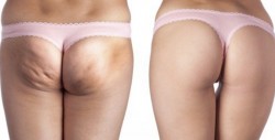 Haz tu propio tratamiento natural contra la celulitis