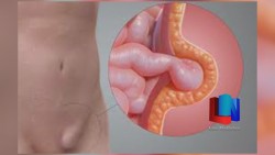 Corrigen hernias con cirugías en Cajeme