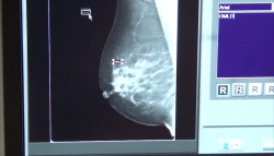 Alta mortalidad en mujeres por cáncer de mama: Javier Saucedo