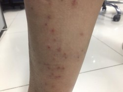 A protegerse del dengue en vacaciones