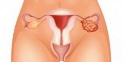 Día Mundial del Cáncer de Ovario