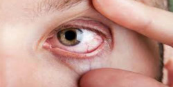 El calor también afecta nuestros ojos