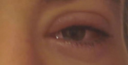 Muy contagiosa la conjuntivitis