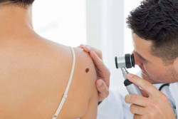 El cáncer de piel tiene alta probabilidad de curación