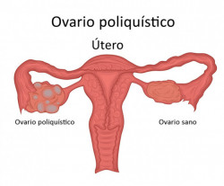 Síndrome de Ovario Poliquístico es un trastorno hormonal frecuente