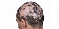 Tratamientos gratuitos para pacientes con alopecia areata