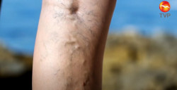 En temporada de calor aumentan problemas de várices
